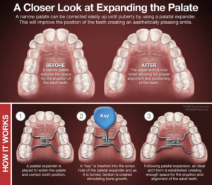 Palatal Expanders Minahan Orthodontics in Olney, MD